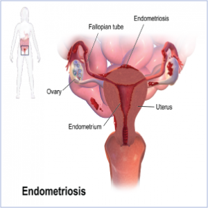endomitriosi
