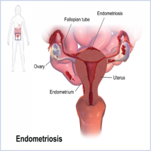 Ενδομητρίωση