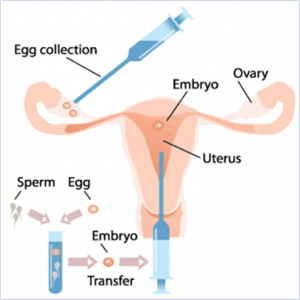 Διαδικασία Εξωσωματικής Γονιμοποίησης