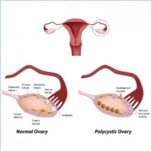 Πολυκυστικές Ωοθήκες